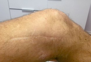 Reha Clinic - Zdjęcie nogi z blizną po operacji